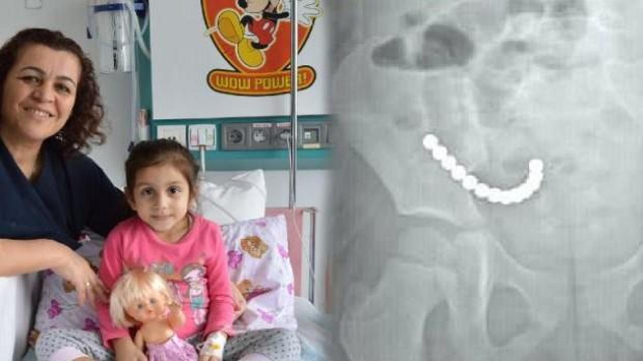 Minik kızın bağırsaklarından çıkanlar şaşkına çevirdi