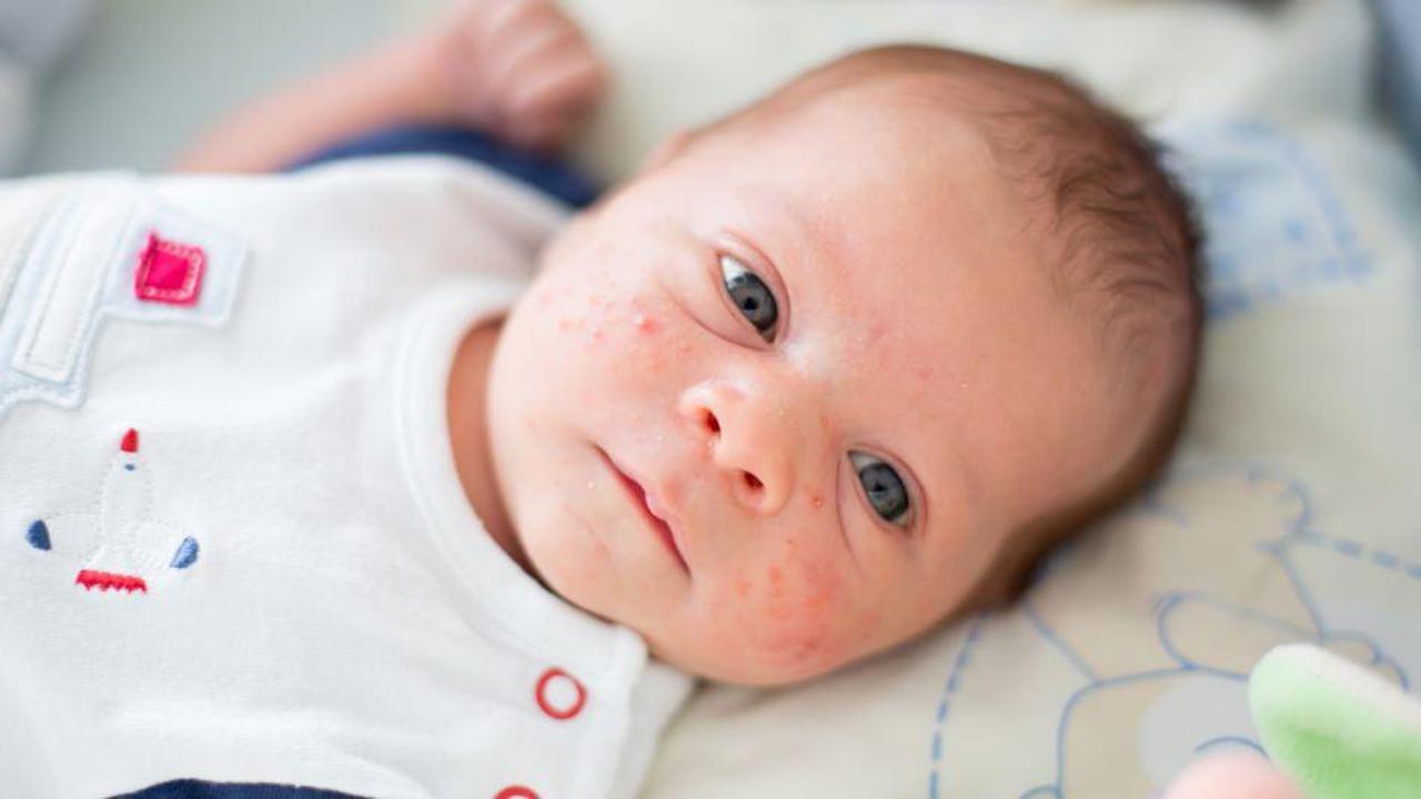 Bebeğin yüzündeki sivilceler nasıl geçer? Sivilce (Milia) kurutma yöntemleri