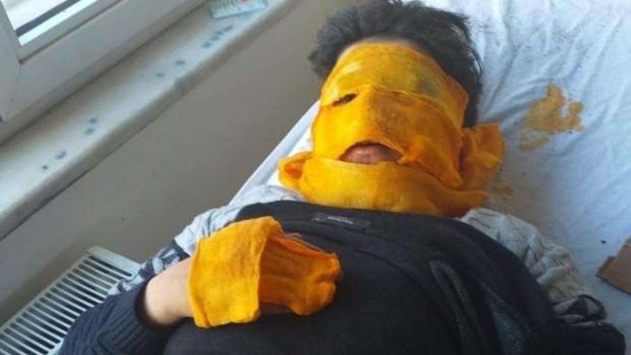 Sprey kutusu patladı, y&uuml;z&uuml; feci şekilde yandı