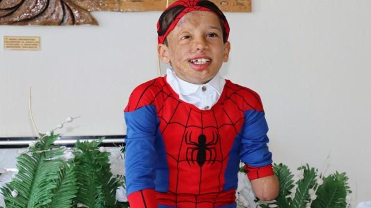 Y&uuml;z nakli olan Ahmed&rsquo;in &Ouml;r&uuml;mcek Adam hayali!