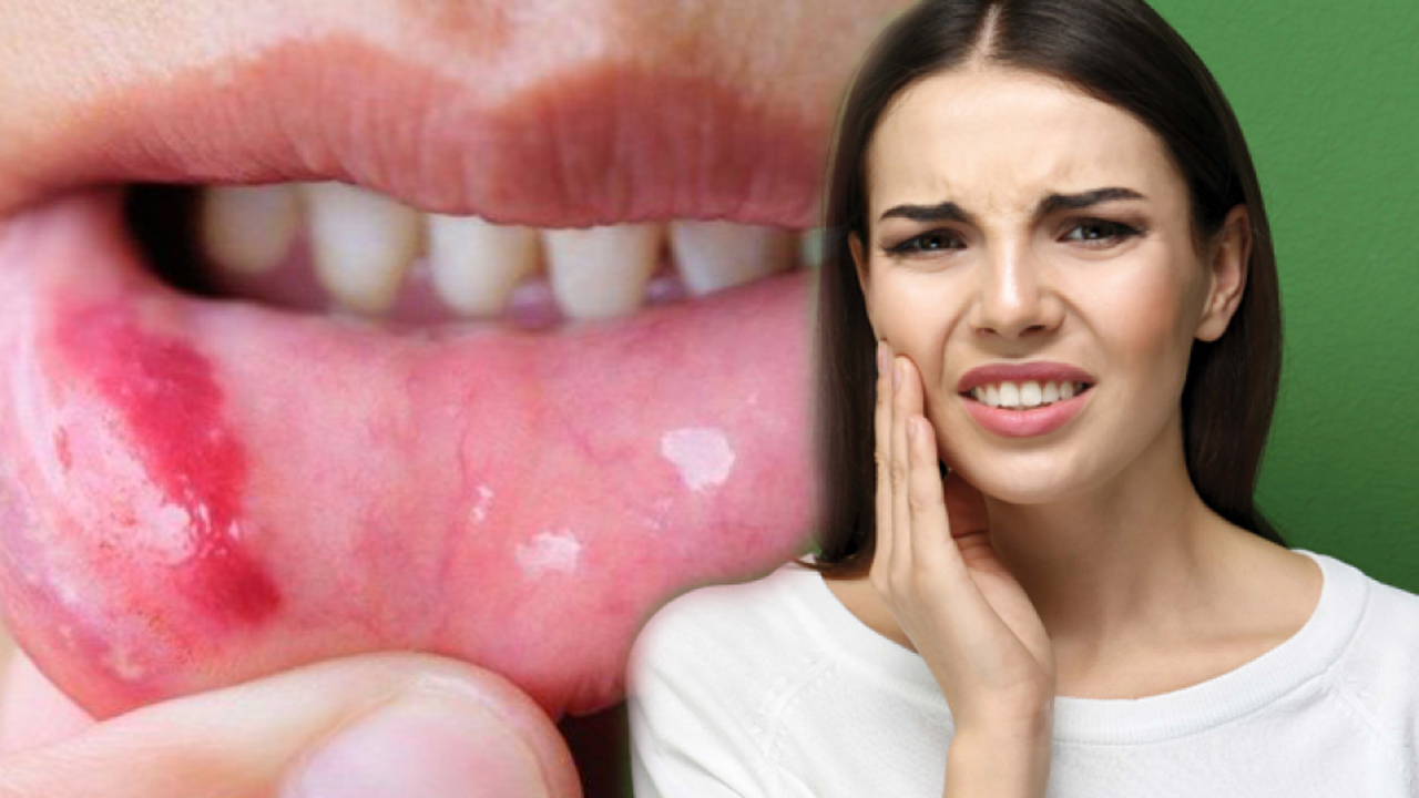 Ağız içi yara nedir ve neden olur? Ağız içi yaralar doğal yolla nasıl geçer?