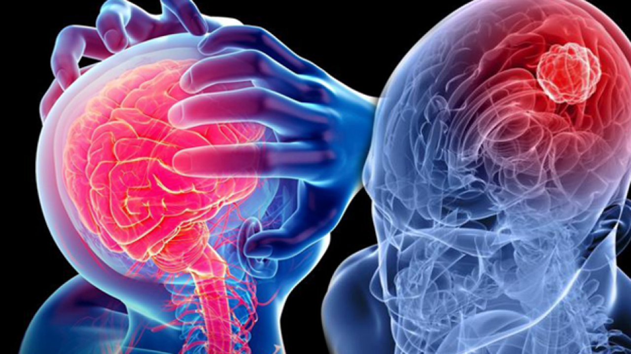 Beyincik (Omurilik) dejenerasyonu nedir? Beyincik (Omurilik) belirtileri nelerdir?