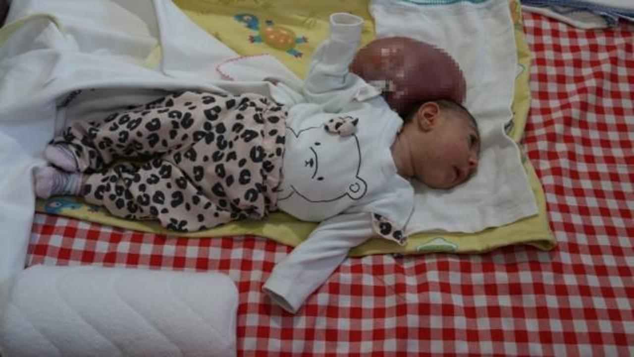 İki kafalı doğan Elif bebeğin anne-babası yardım istiyor