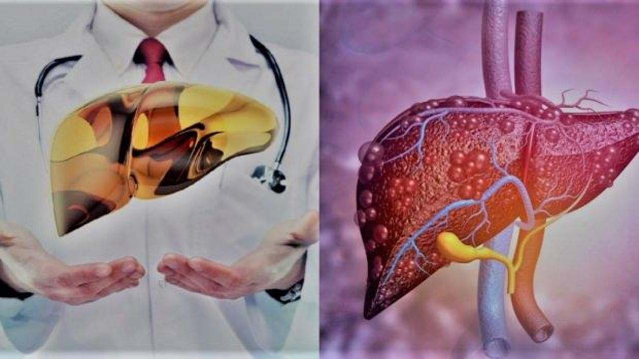 Karaciğer yağlanmasını ne temizler: Karaciğer yağlanmasına iyi gelen tedavi yöntemleri