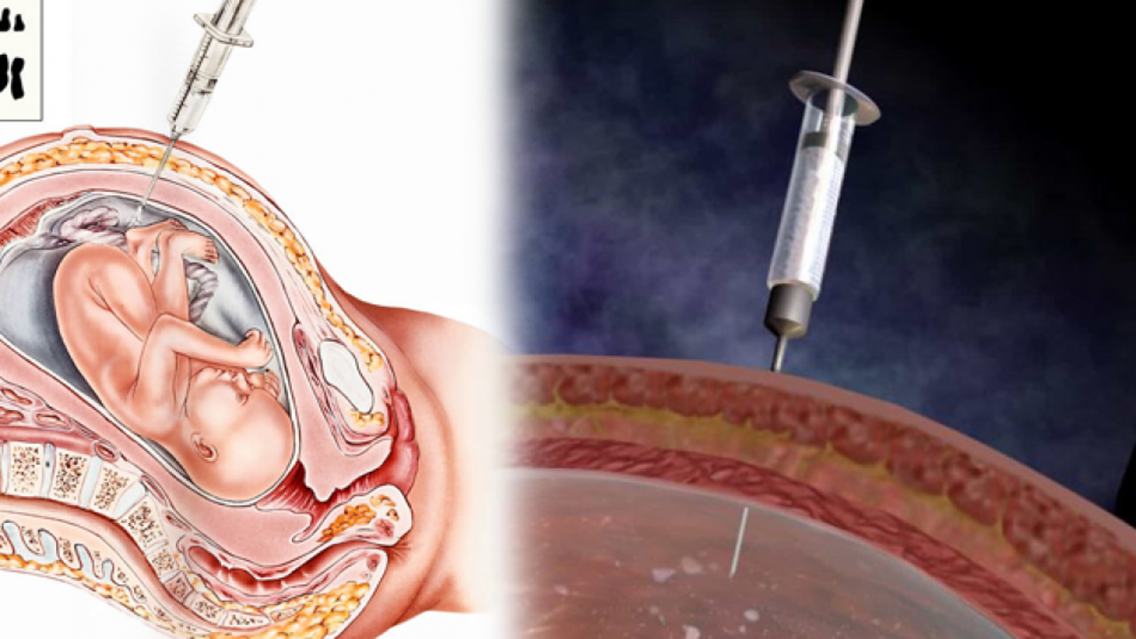 Amniyosentez nedir, ne işe yarar? Amniyosentez testi ile ilgili merak edilenler