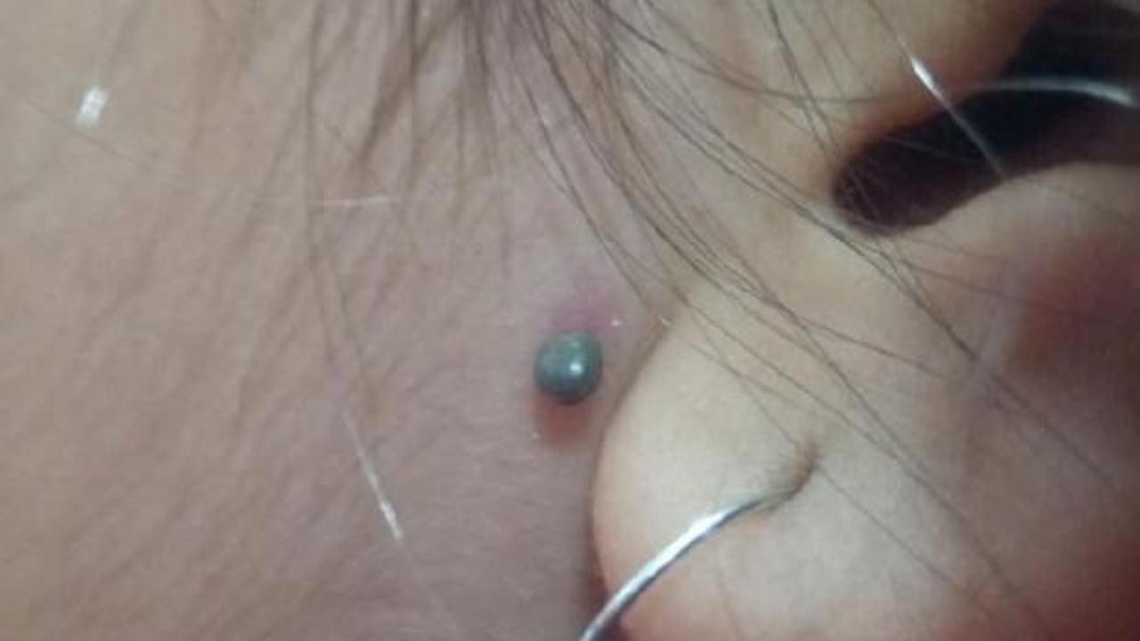 Liseli kızın kulağının yanından kene ısırdı!