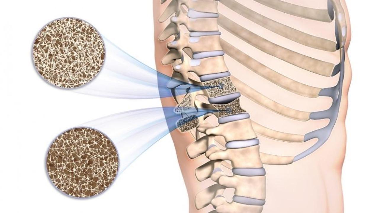 Kemik erimesi (Osteoporoz) nedir? Kemik erimesi belirtileri nelerdir ve tedavisi var mıdır?