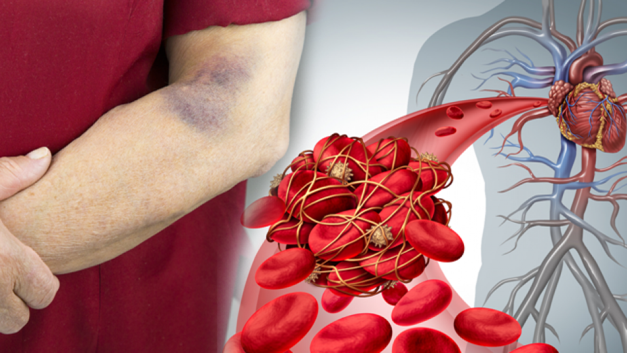 Kan pıhtılaşması nedir? Kan pıhtılaşması belirtileri nelerdir ve tedavisi var mıdır?