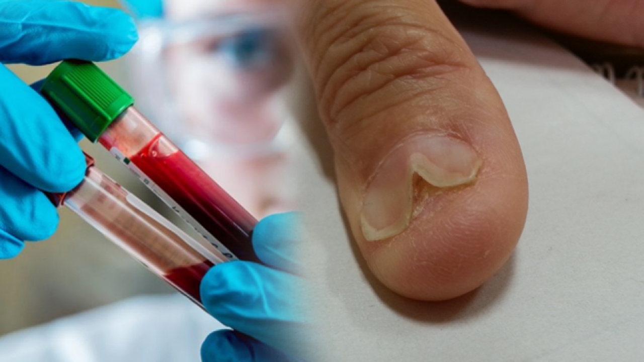 Ferritin eksikliği nedir? Ferritin eksikliğinin belirtileri nelerdir? Ferritin içeren besinler nelerdir?