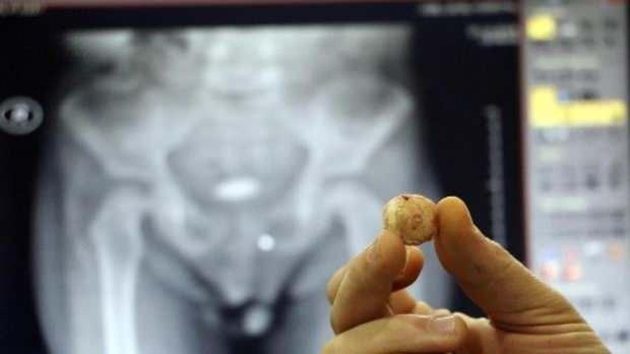 3 yaşındaki &ccedil;ocuğun mesanesinden &ccedil;ıkan taş şaşırttı