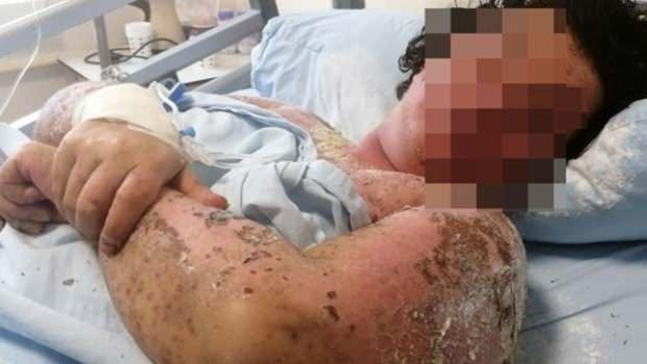 Antibiyotik y&uuml;z&uuml;nden tanınmaz hale geldi