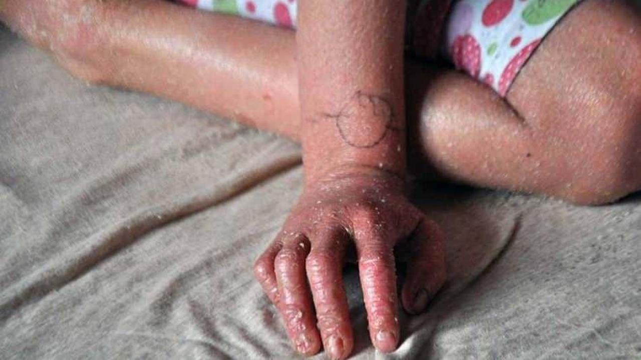 Balık pulu hastalığı nedir? Balık pulu hastalığı nasıl ge&ccedil;er? Balık pulu tedavisi