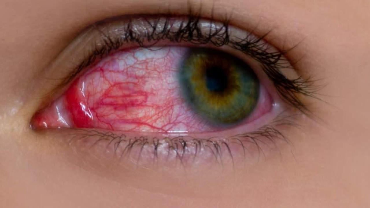 Göz alerjisi neden olur? Göz alerjisinin belirtileri nelerdir? Göz alerjisine ne iyi gelir? 