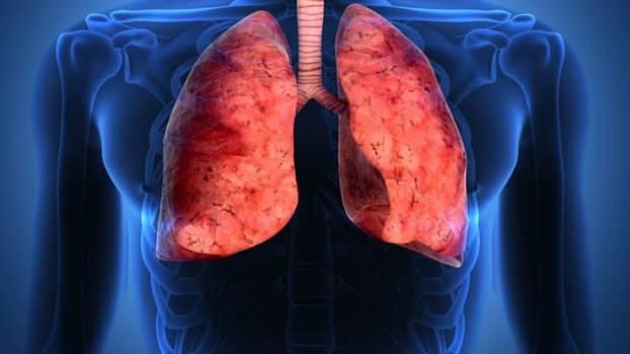 Akciğer kanserinin belirtileri nelerdir? Akciğer kanseri tedavisi nasıl olur?
