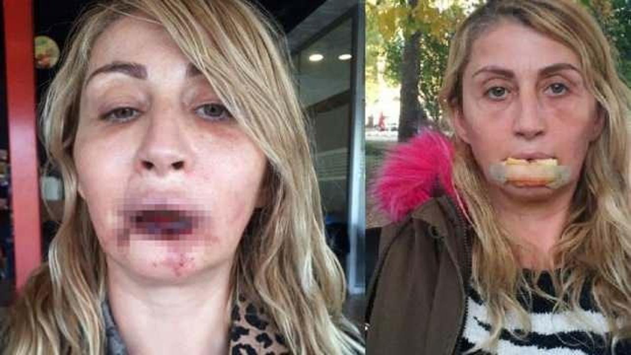 Güzellik uğruna dudağını kaybeden kadın iyileşti!