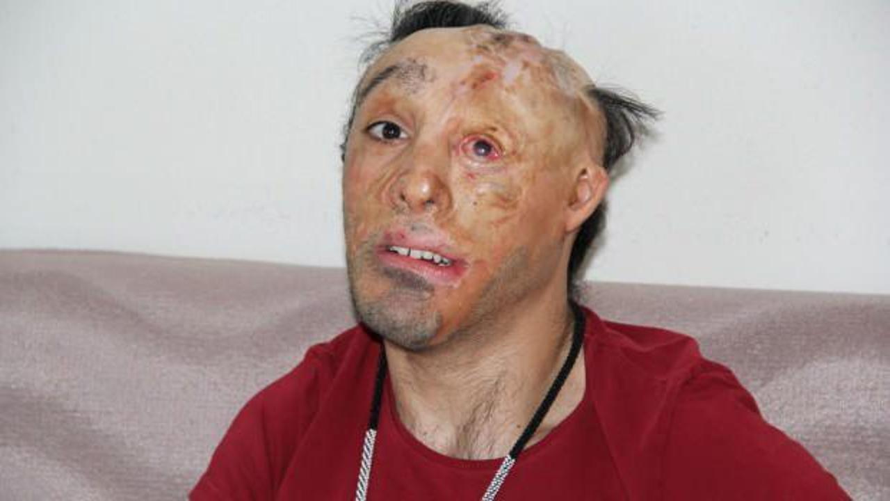 6 aylıkken y&uuml;z&uuml; yanmıştı, operasyonuna korona engel oldu