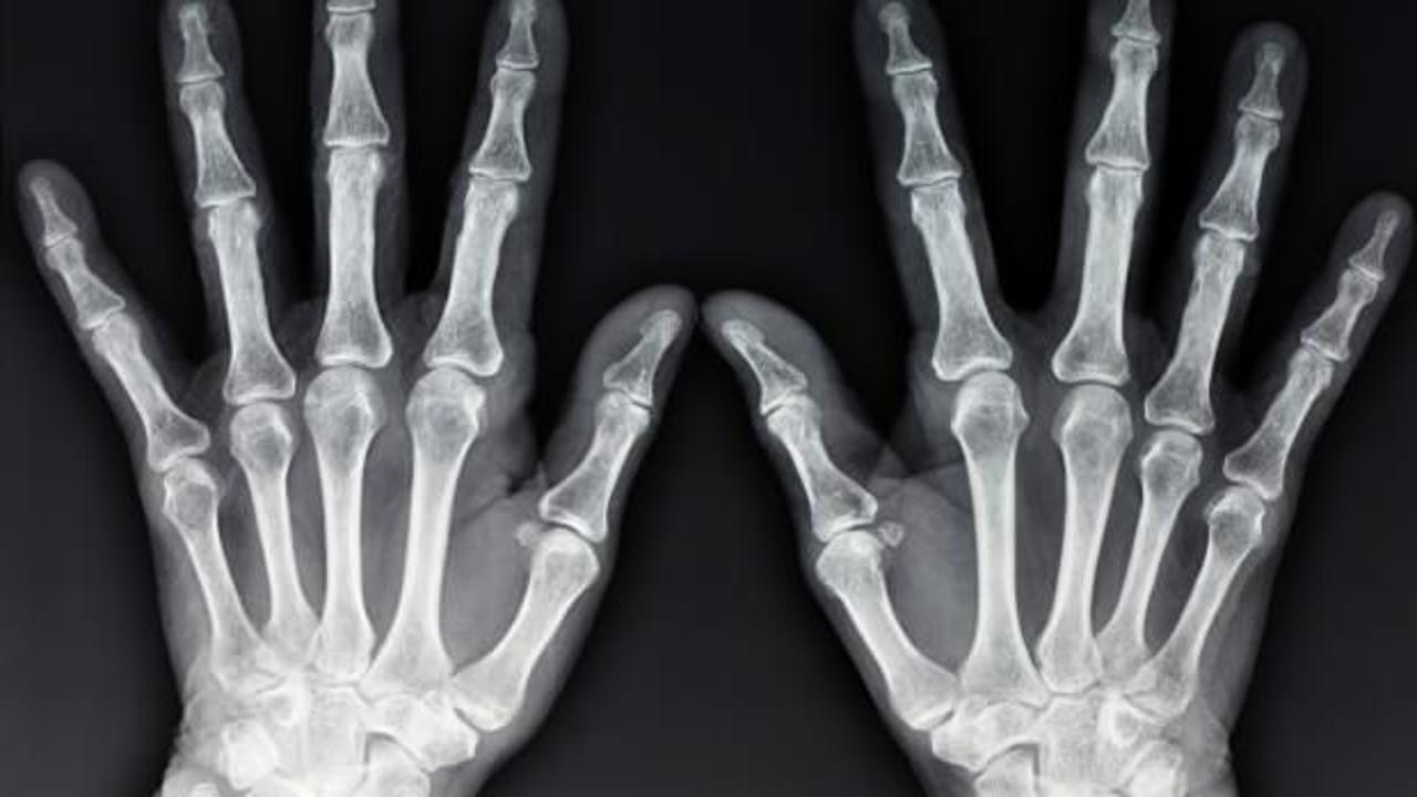 Parmak çıtlatmanın zararları nelerdir? Parmak çıtlatma nasıl bırakılır? 
