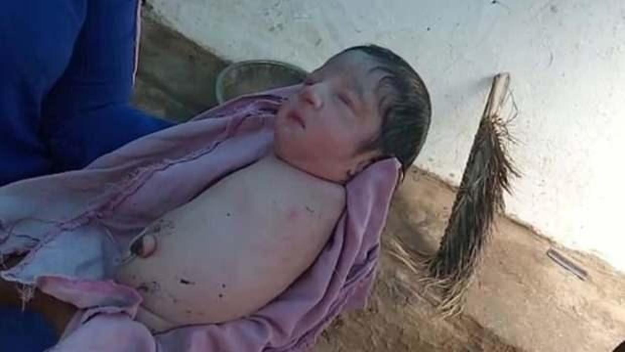 Hindistan’da kolları ve bacakları olmadan doğan bebek şaşkınlığı