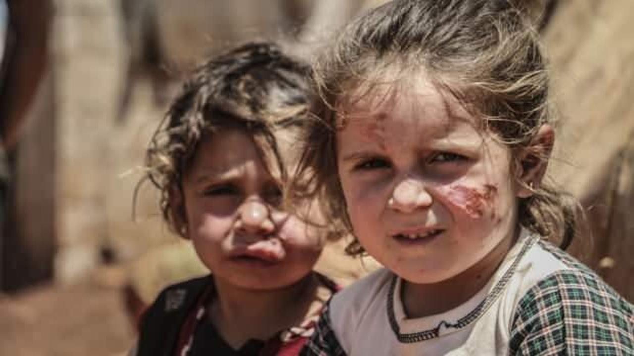 İdlib’deki sığınmacı kamplarında şark çıbanı hastalığı yayılıyor