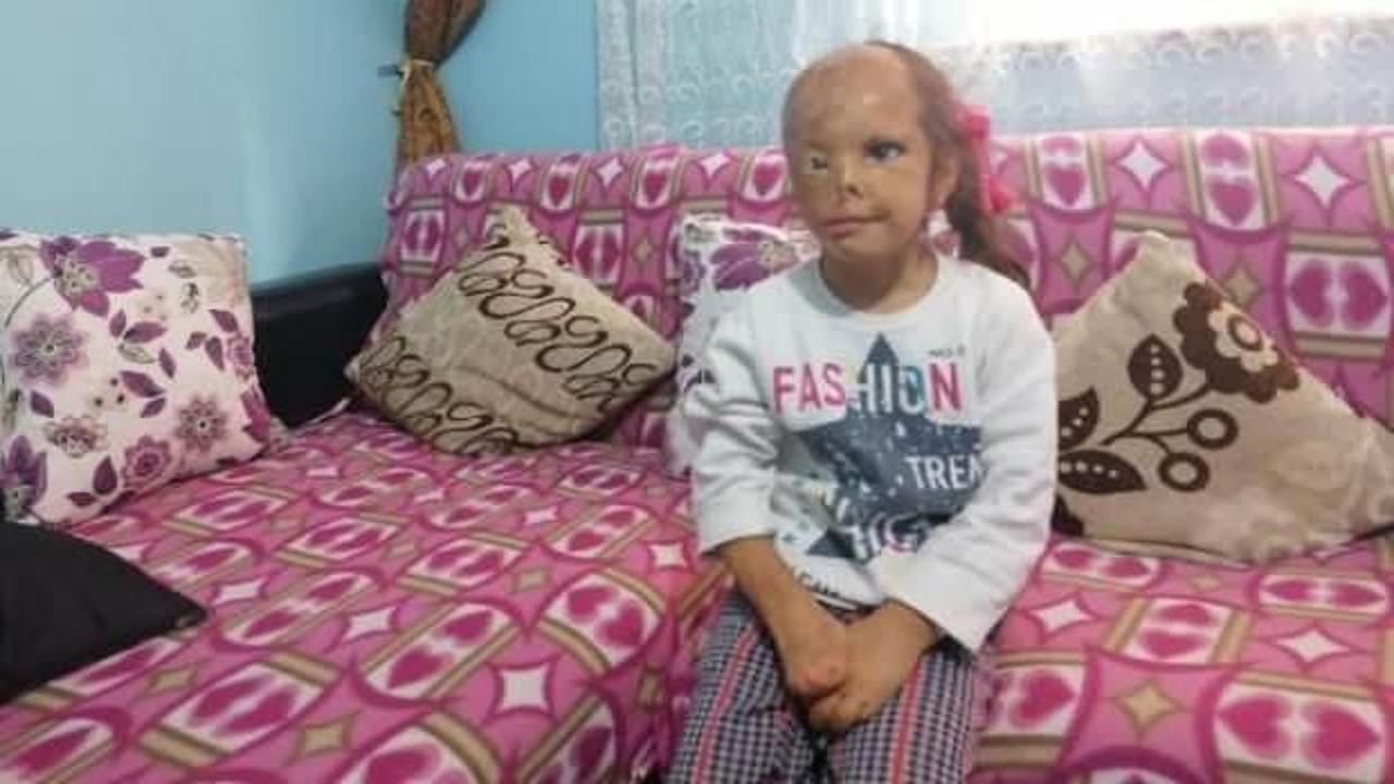 Bebekken y&uuml;z&uuml; yanan Dilara, ameliyat i&ccedil;in yardım bekliyor