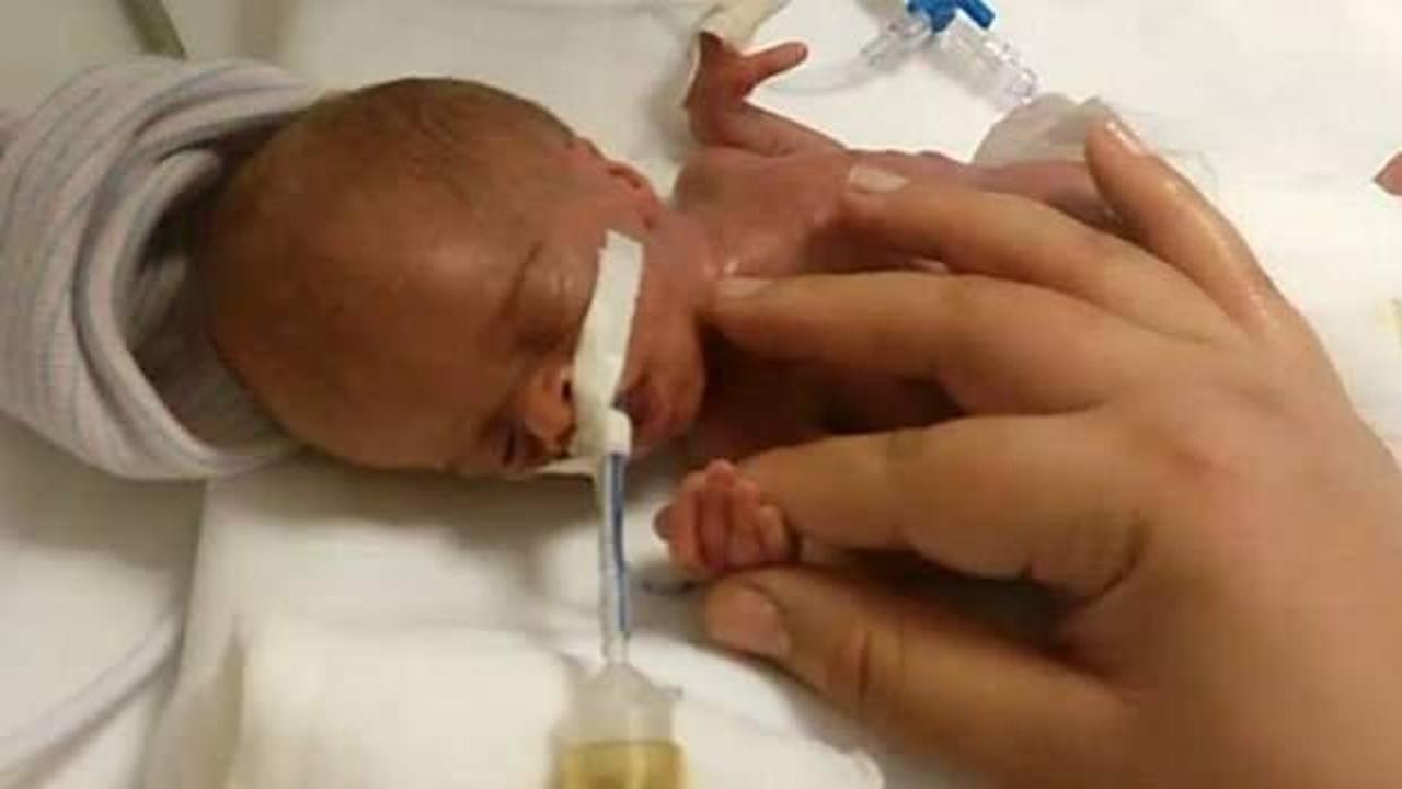 Parmak bebek olarak doğdu, 4.5 yıl y&uuml;r&uuml;yemedi! Şimdi...