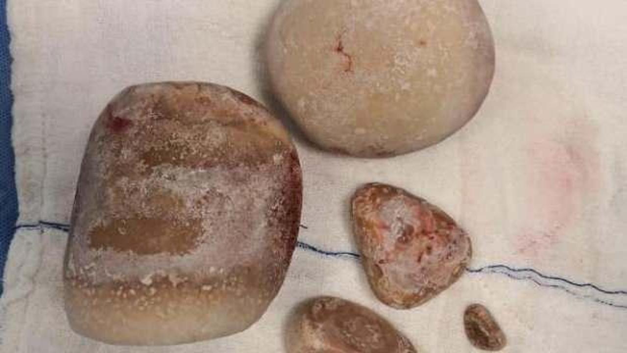 Mesanesinden &ccedil;ıkan taşlar doktorları şaşırttı!