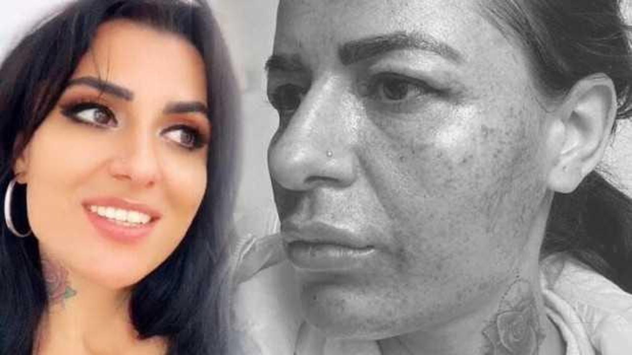 G&uuml;zellik merkezinde hayatının şokunu yaşadı! Y&uuml;z&uuml; yandı, tehdit edildi