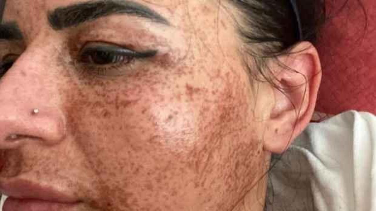 Cilt toparlama ilanıyla hayatı kabusa d&ouml;nd&uuml;