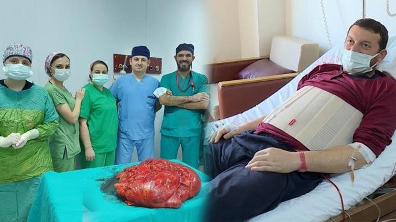 Trabzon'da 'karnım şiş' şikayetiyle hastaneye başvuran adamdan 21 kiloluk tümör alındı!