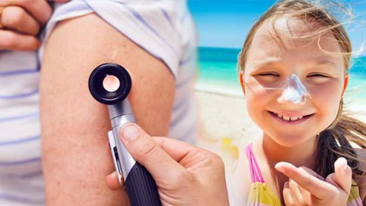 Çocukluktaki güneş yanıkları deri kanseri riskini arttırıyor!