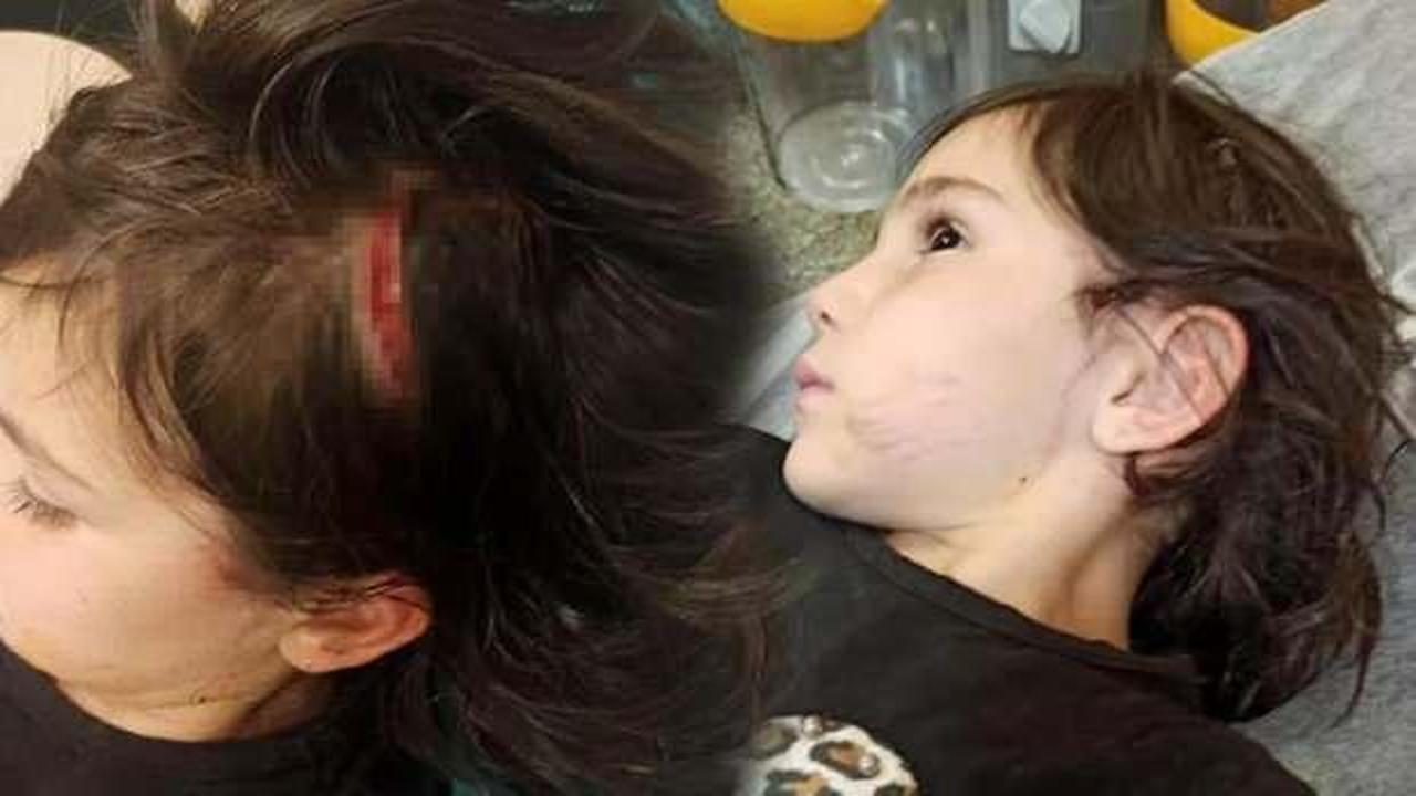 6 yaşındaki Narin, sevdiği köpeğin saldırısında yaralandı