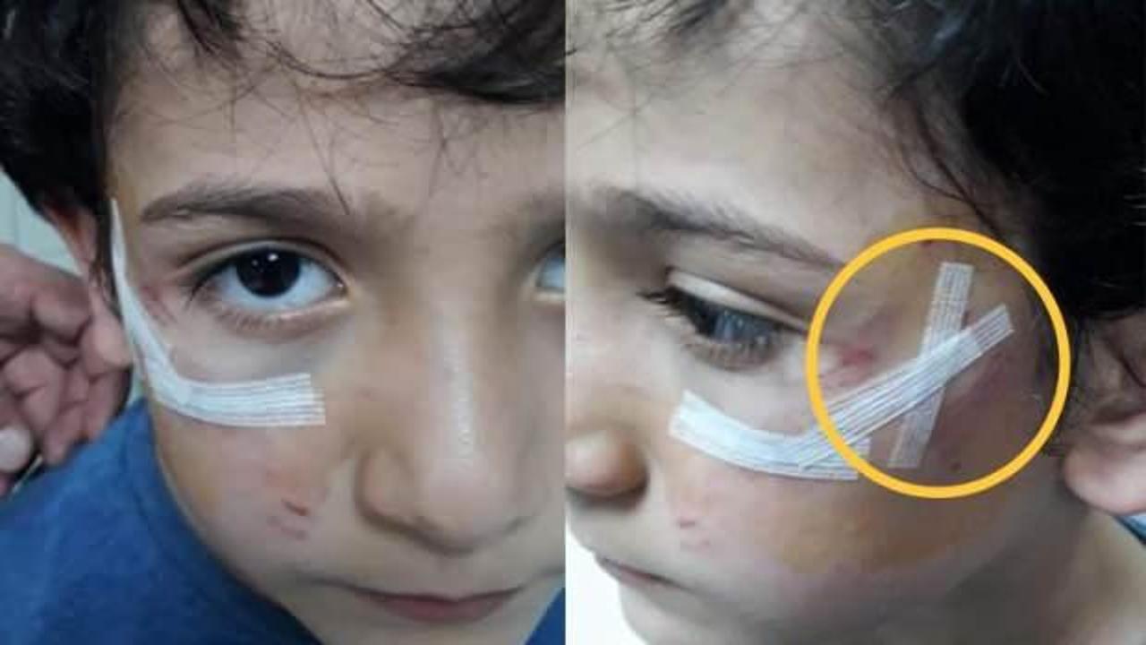 Bursa'da köpek dehşeti! 8 yaşındaki çocuğun yanağını koparıyordu