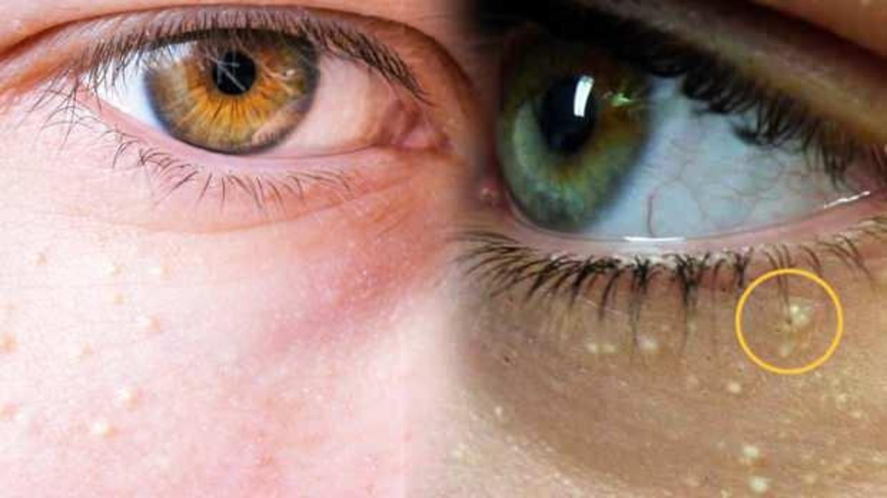 Göz çevresi yağ bezelerine dikkat! Kolesterol sebebi olabilir