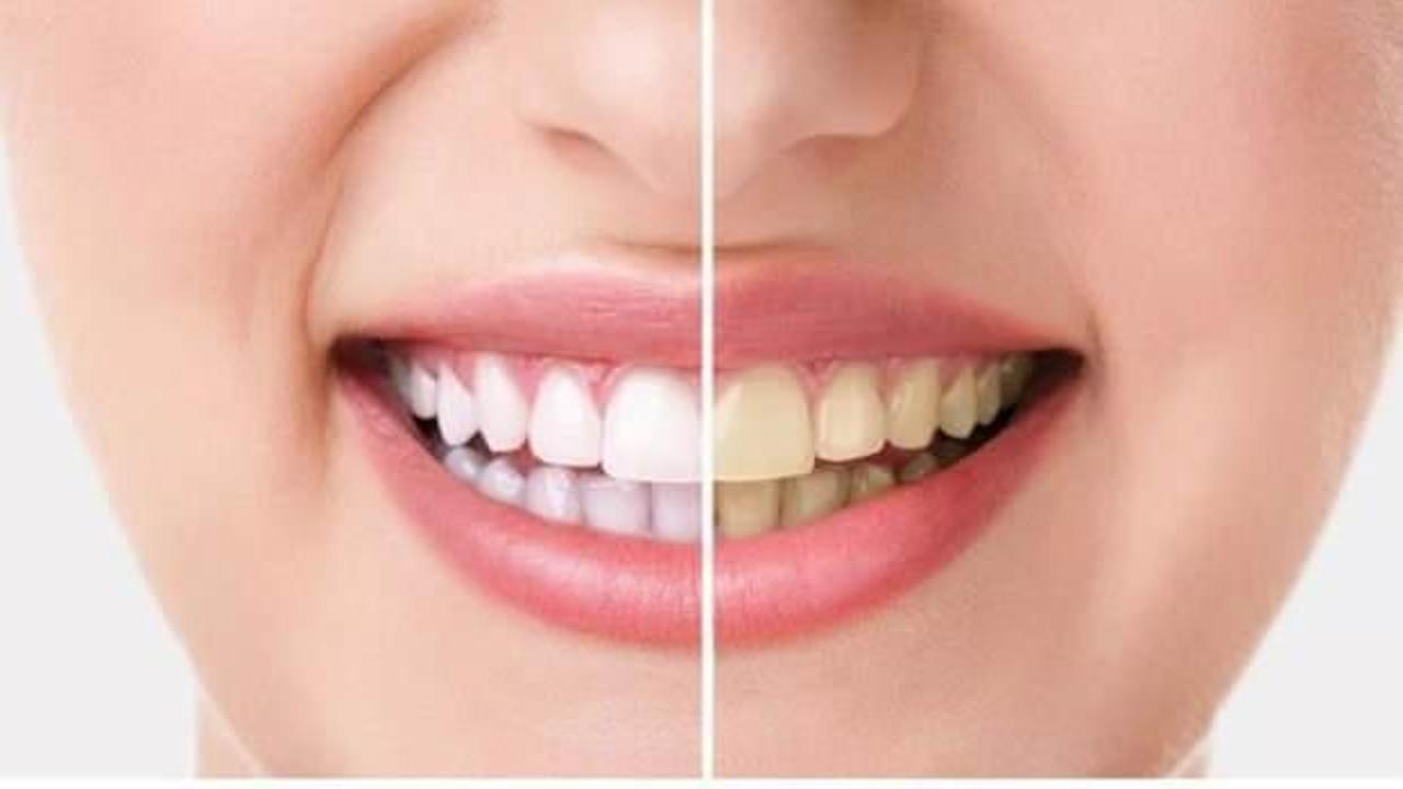 Dişlerde ağartma işlemi bilinçsiz yapıldığında kalıcı hasarlara neden oluyor