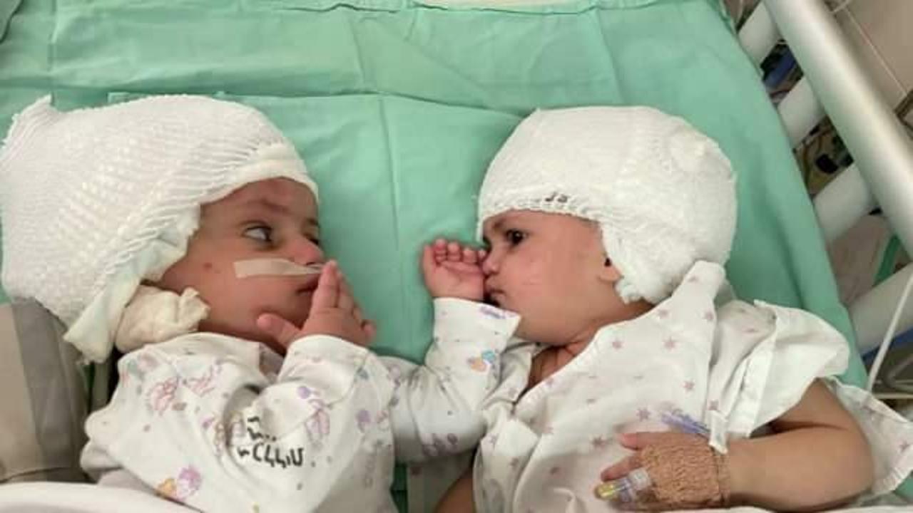 Kafaları yapışık doğan ikizler 12 saatlik ameliyatla ayrıldı