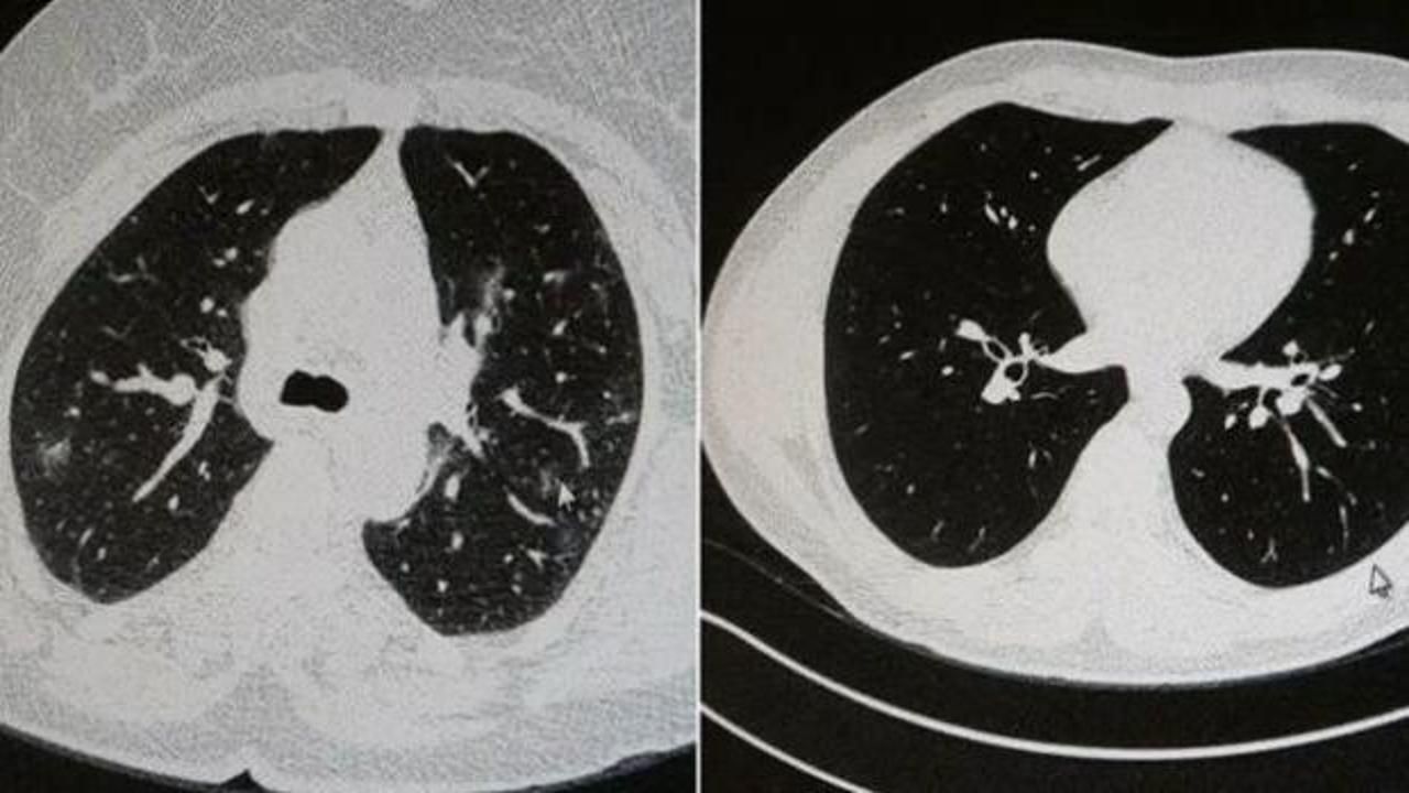 Aşılı ve aşısız kovidli 2 gencin akciğer tomografisi arasındaki fark görüntülendi