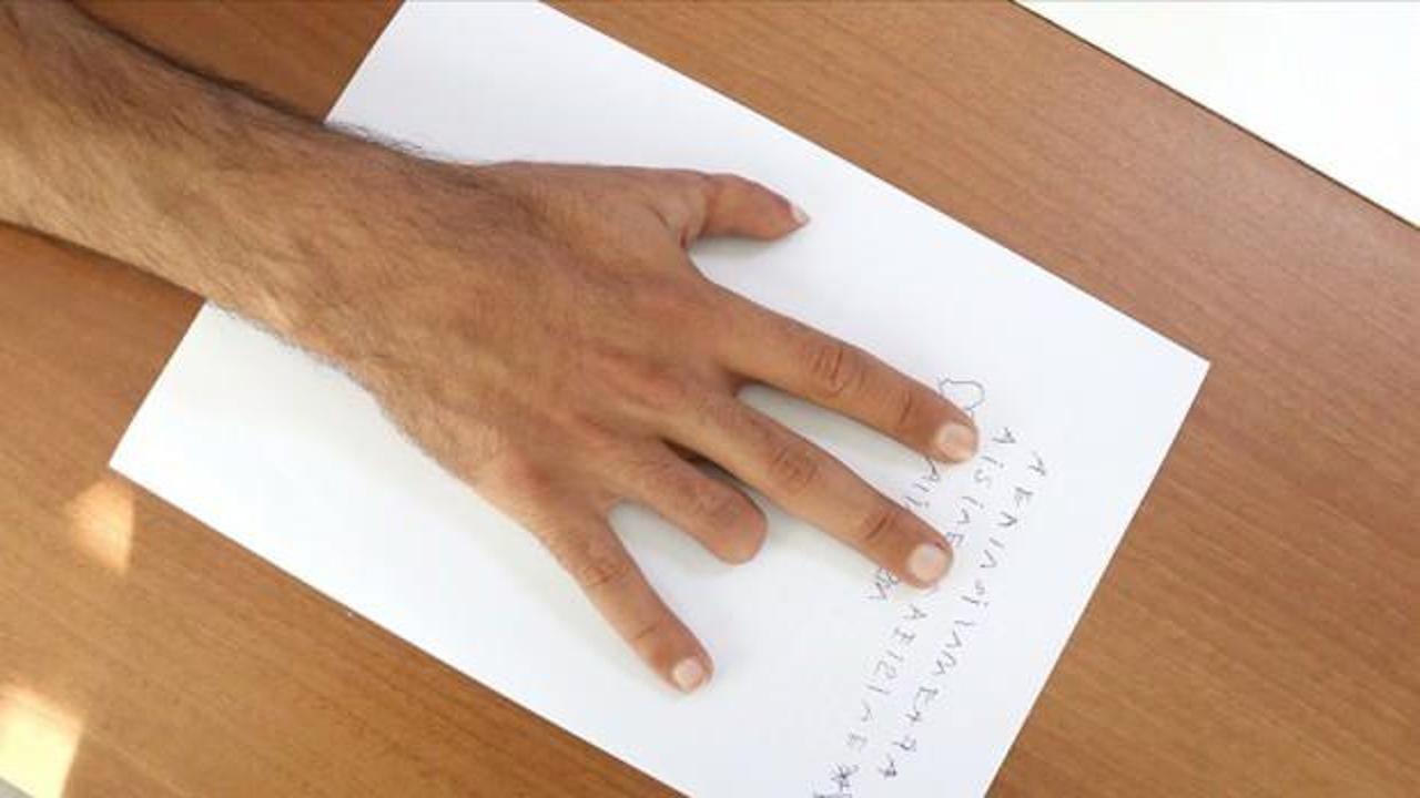 Konya'da literatüre giren parmak nakli! Yüzük parmağı baş parmağı oldu