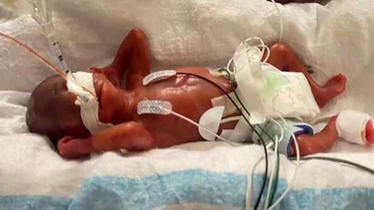 420 gram doğdu, dünyanın en prematüre bebeği oldu