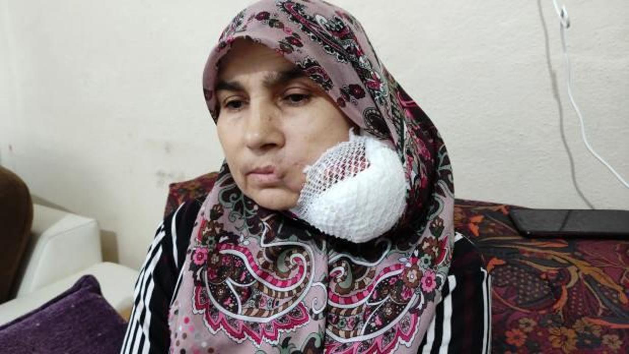 Bursa'da talihsiz kadın yüzündeki dev kitleden kurtulmak için yardım bekliyor