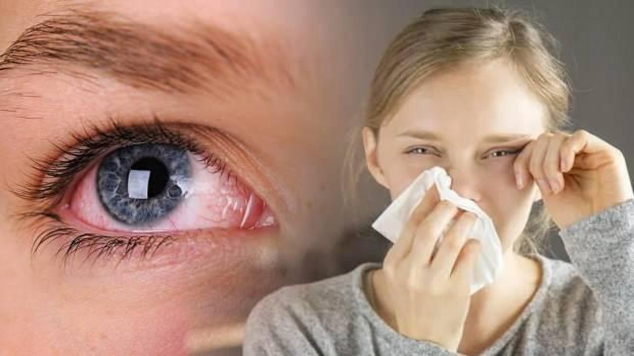 Göz nezlesi nasıl geçer? Alerjik göz nezlesi belirtileri nelerdir?