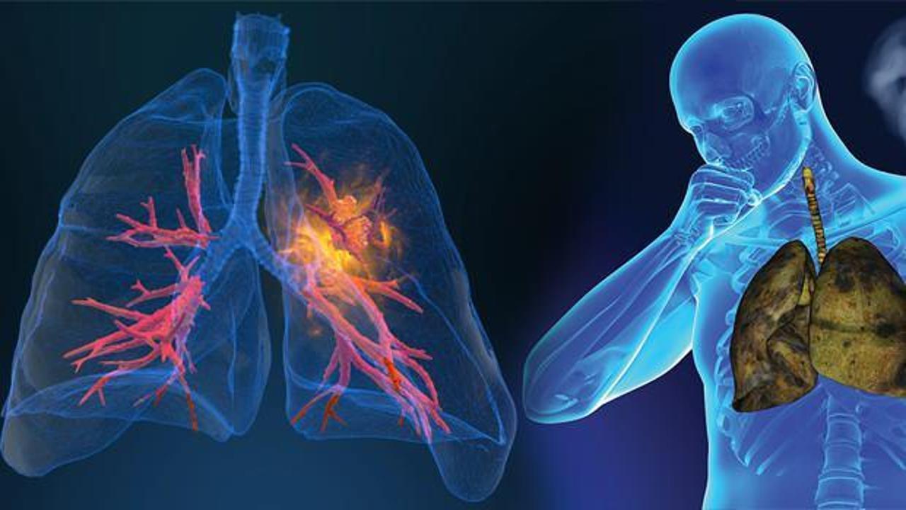 Akciğer kanseri görülme yaşı 30'lara kadar düştü