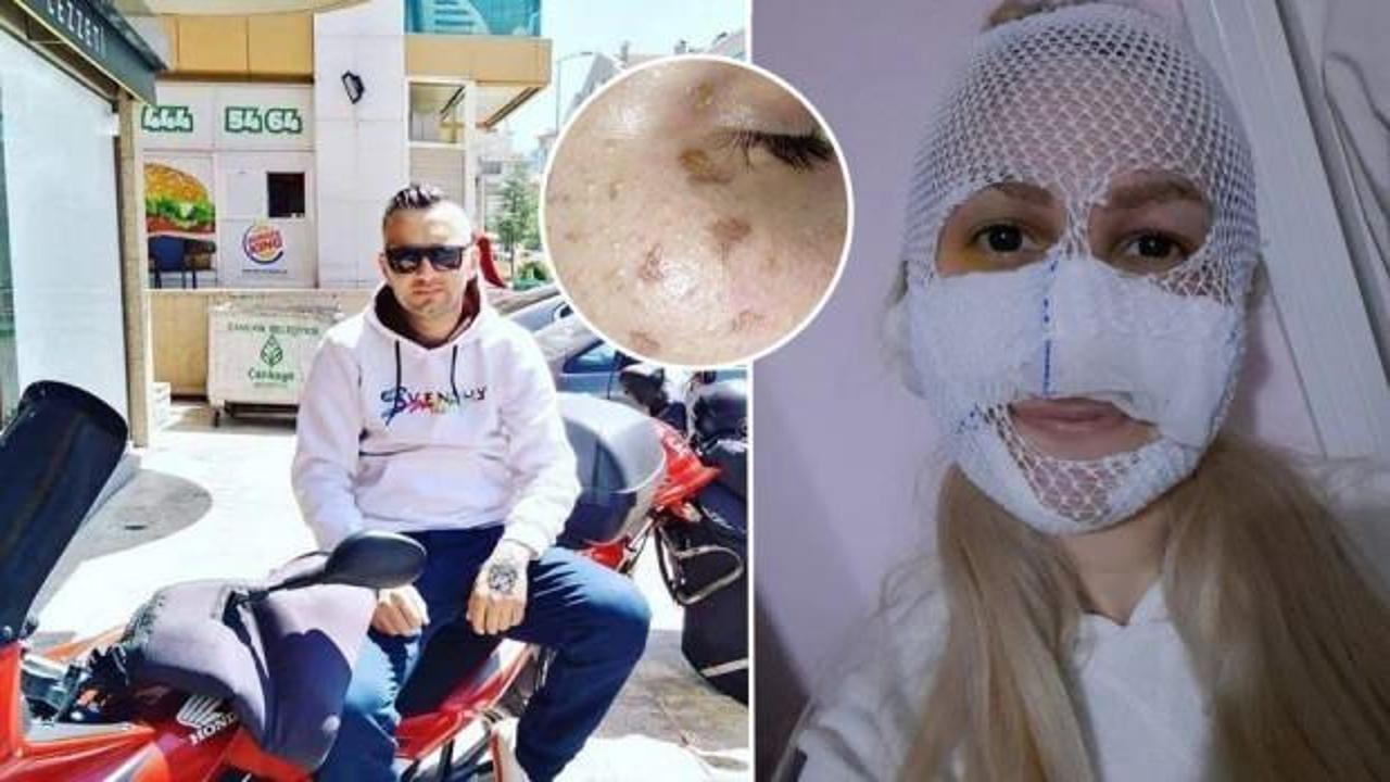 Eski kız arkadaşının yüzüne kimyasal madde atan sanık tutuklandı