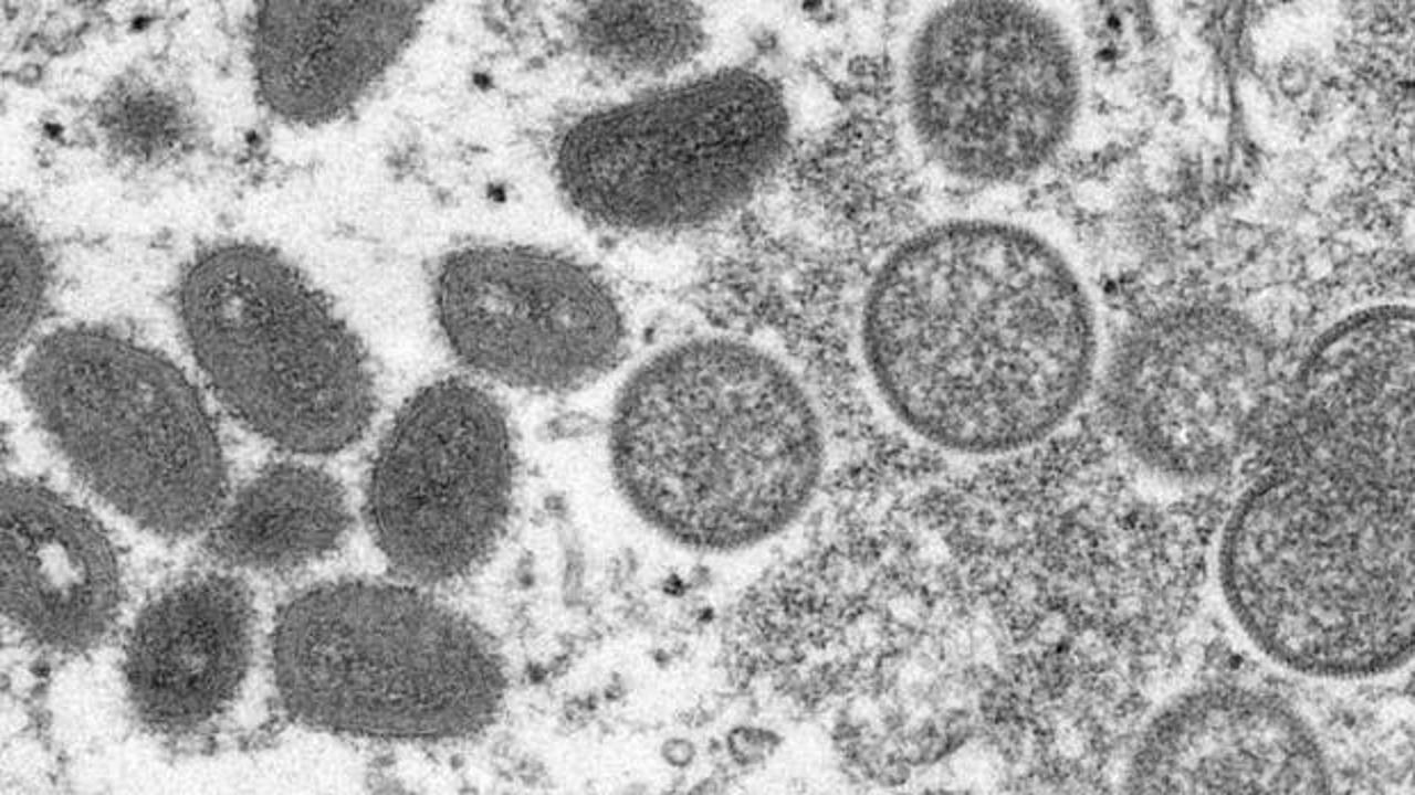 ABD'de korkutan ilk: Maymun çiçeği virüsü tespit edildi