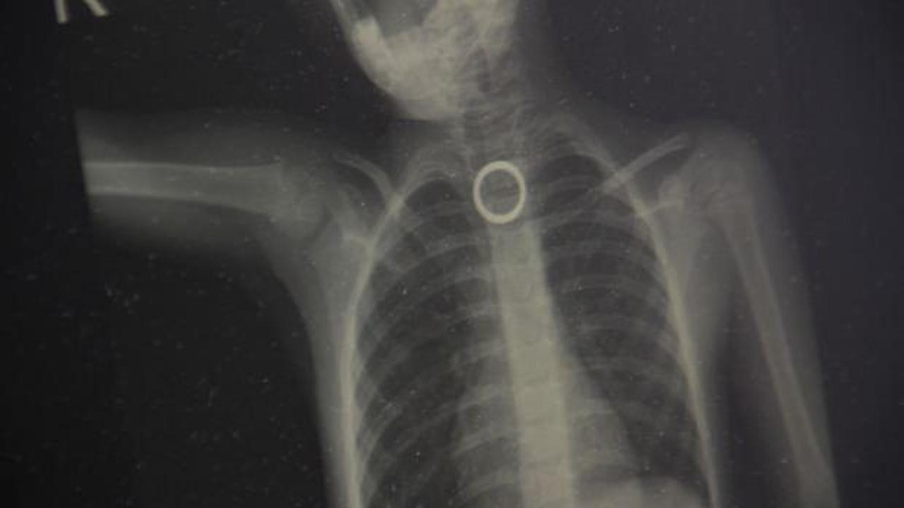 Y&uuml;z&uuml;k yutan 3 yaşındaki &ccedil;ocuk &ouml;l&uuml;mden d&ouml;nd&uuml;  