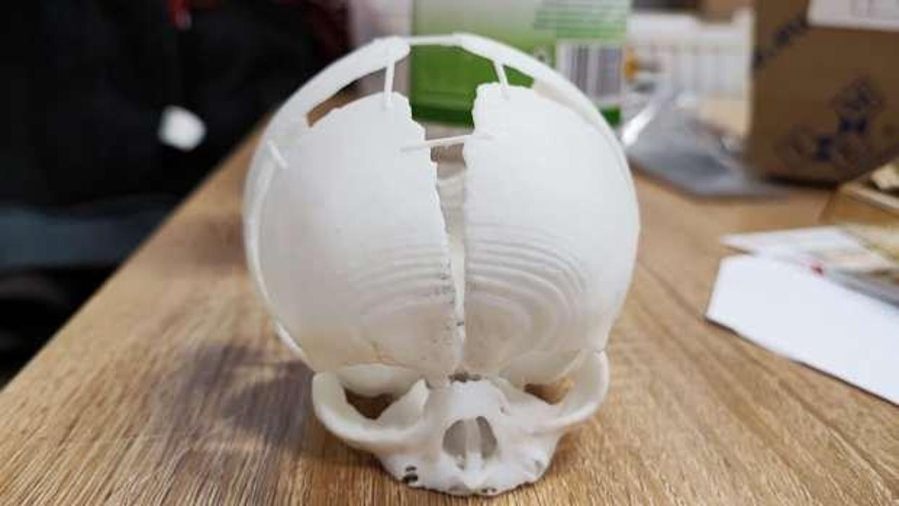 Kafatası olmadan doğan bebeğin hayatını 3D yazıcıyla üretilen kafatası kurtardı