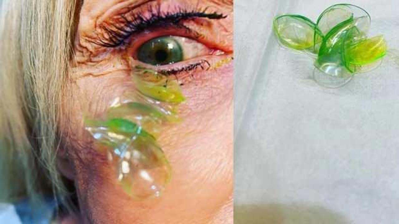 ABD'de hastanın gözünden 23 kontakt lens çıkarıldı