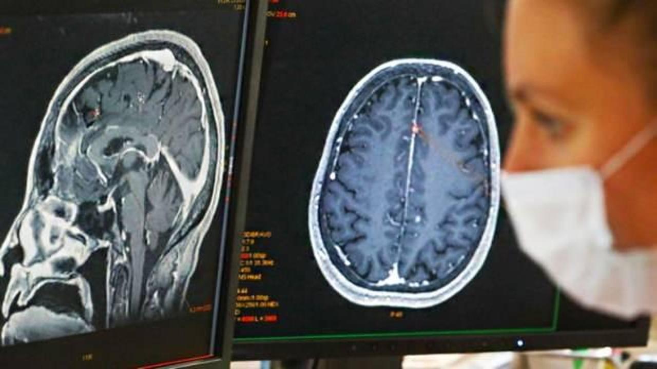 Araştırma: Kovid-19 sonrası gençlerin beyinleri daha hızlı yaşlanıyor