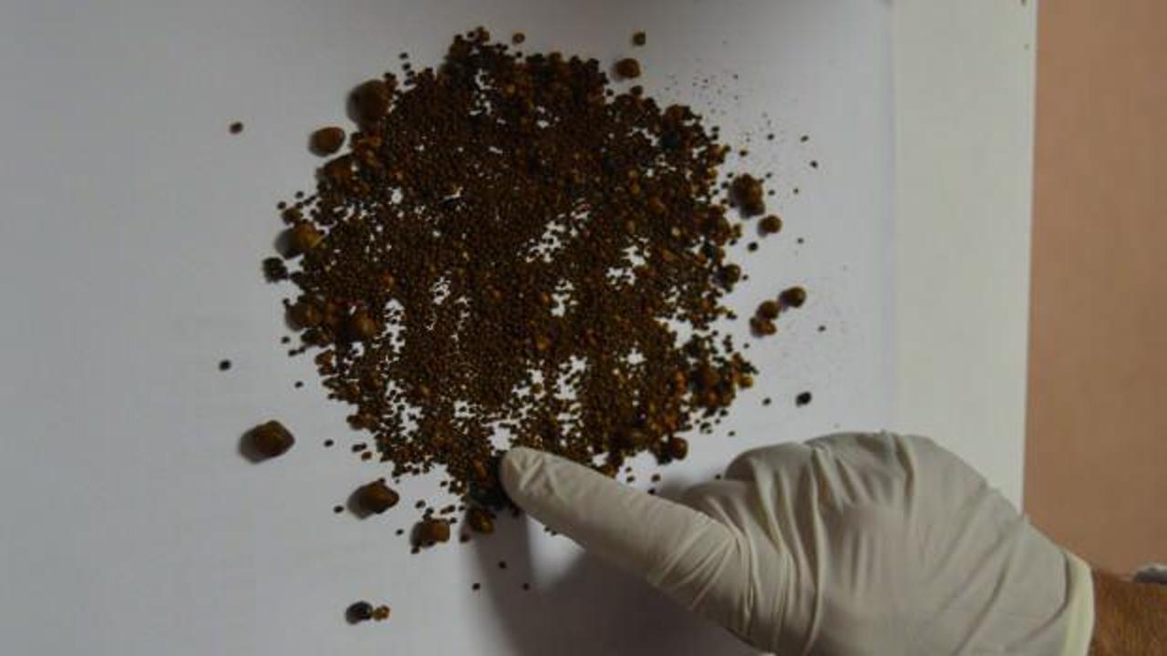 Safra kesesinden tam 4 bin 536 adet taş &ccedil;ıktı