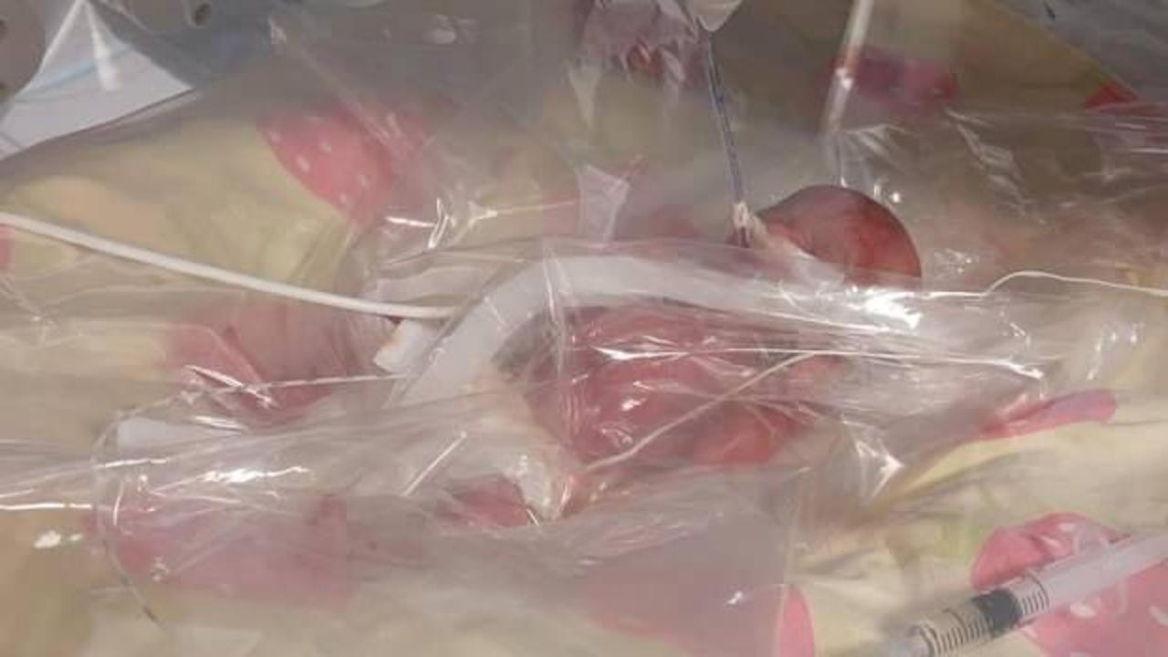 Tekirdağ'da nadir g&ouml;r&uuml;len olay! 310 gram bebek doğdu