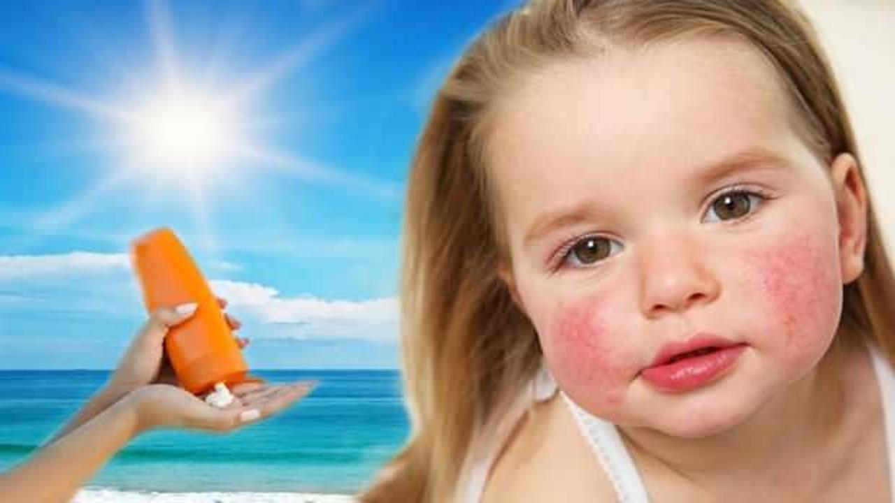 Güneş alerjisine ne iyi gelir, nasıl geçer? Güneş alerjisi belirtileri nelerdir?
